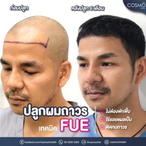 FUE