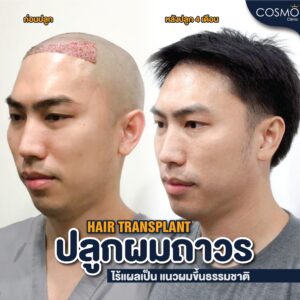 ปลูกผมไร้ไม่ผ่าตัด