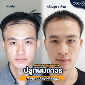 รีวิวปลูกผม