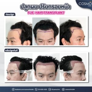 ก่อนปลูกผม