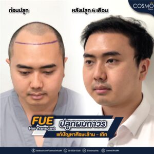 ปลูกผม6เดือน
