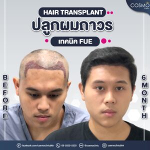 Hair loss