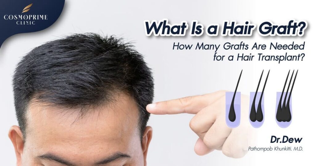 What Is a Hair Graft?
