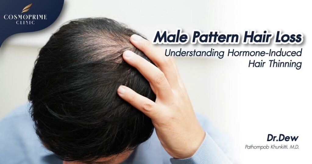 Male Pattern Hair Loss