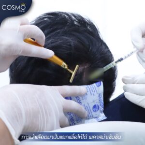 PRP Be Combined With Hair Transplant?