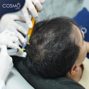 PRP Hair Treatment Cost