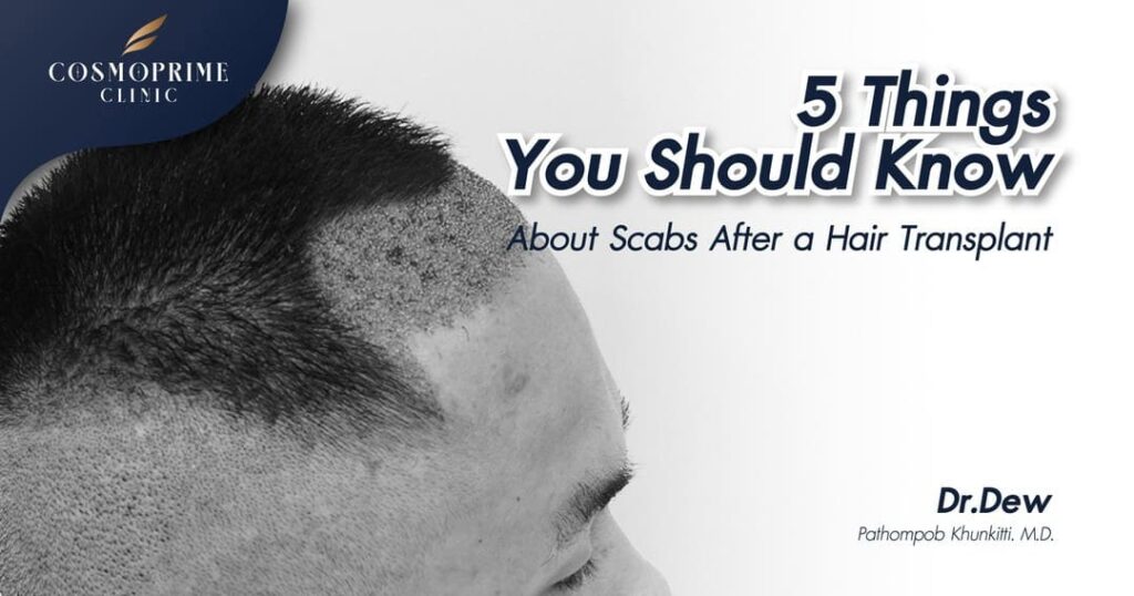 5 Things You Should Know About Scabs After a Hair Transplant