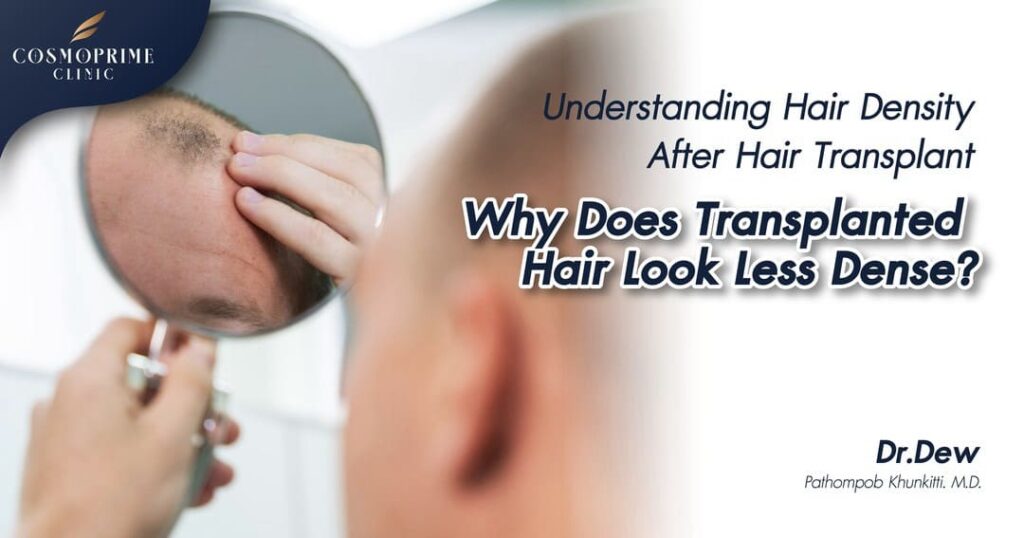 Why Does Transplanted Hair Look Less Dense?