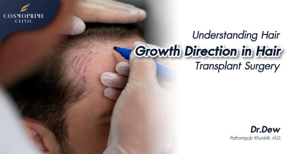 Understanding Hair Growth Direction in Hair Transplant Surgery