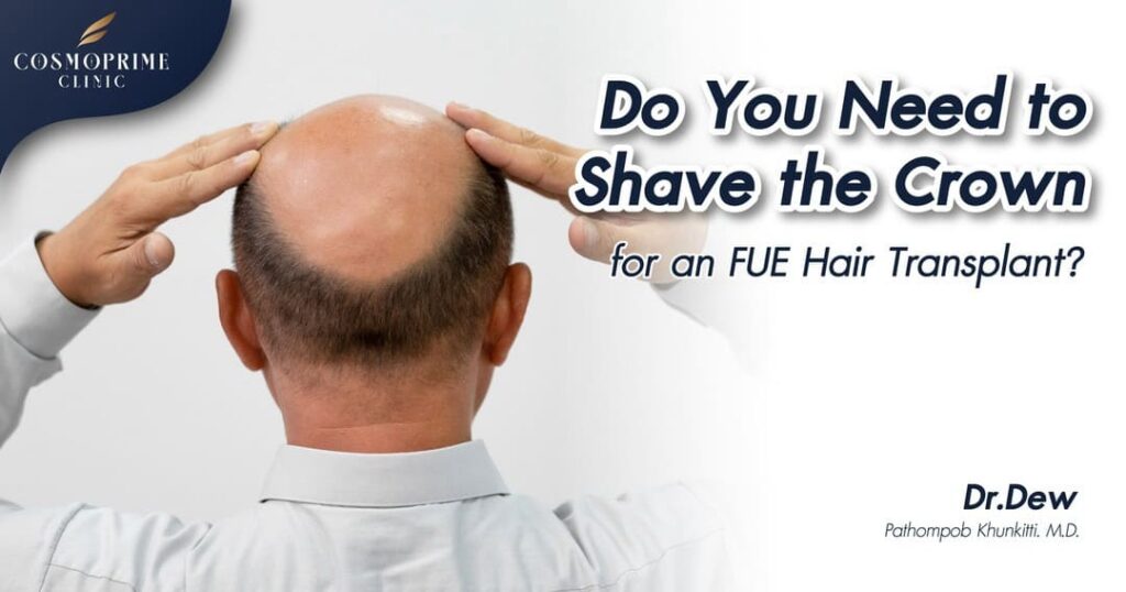 Do You Need to Shave the Crown for an FUE Hair Transplant?
