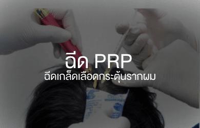 ฉีดเกล็ดเลือด PRP