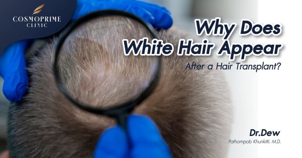 Why Does White Hair Appear After a Hair Transplant?