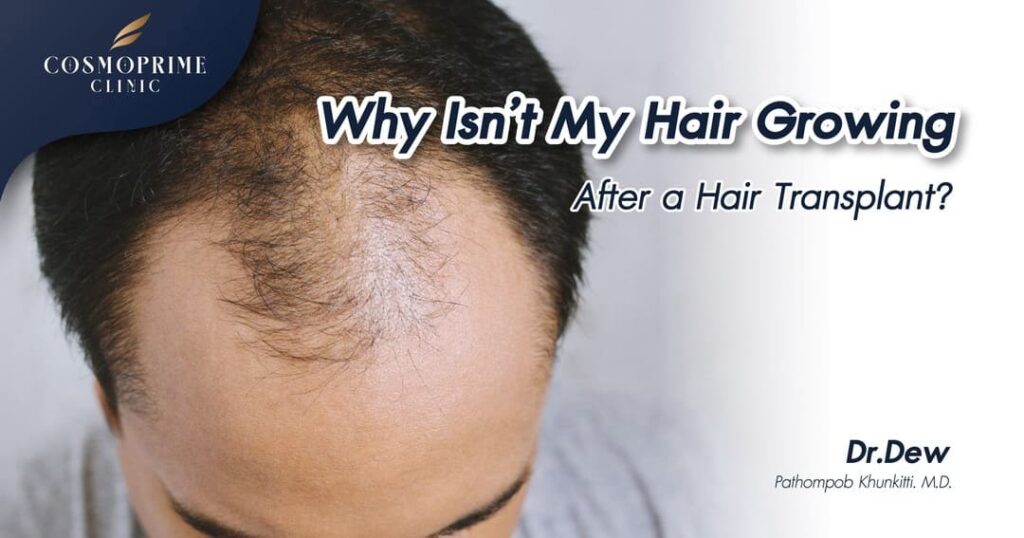 Why Isn’t My Hair Growing After a Hair Transplant?