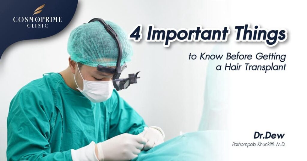 4 Important Things to Know Before Getting a Hair Transplant