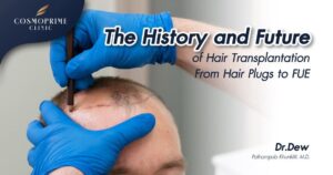 The History and Future of Hair Transplantation: From Hair Plugs to FUE