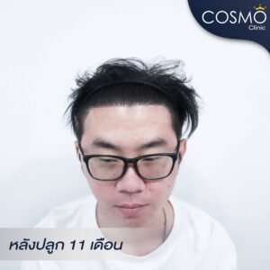 ปลูกผม