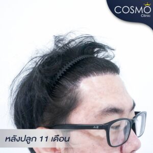 ปลูกผม