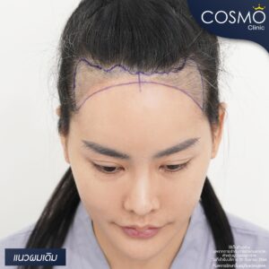 FUE hair transplant clinic in Bangkok