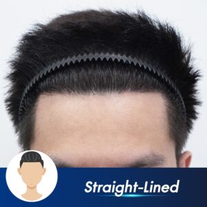 Natural hairline design planning before hair transplant at CosmoPrime Clinic Bangkok