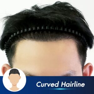 Natural hairline result after hair transplant showing soft and realistic frontal hairline
