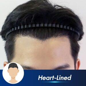 Natural hairline restoration performed under medical supervision at CosmoPrime Clinic Bangkok