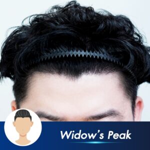 natural hairline result