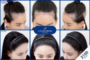 hair transplant cost
