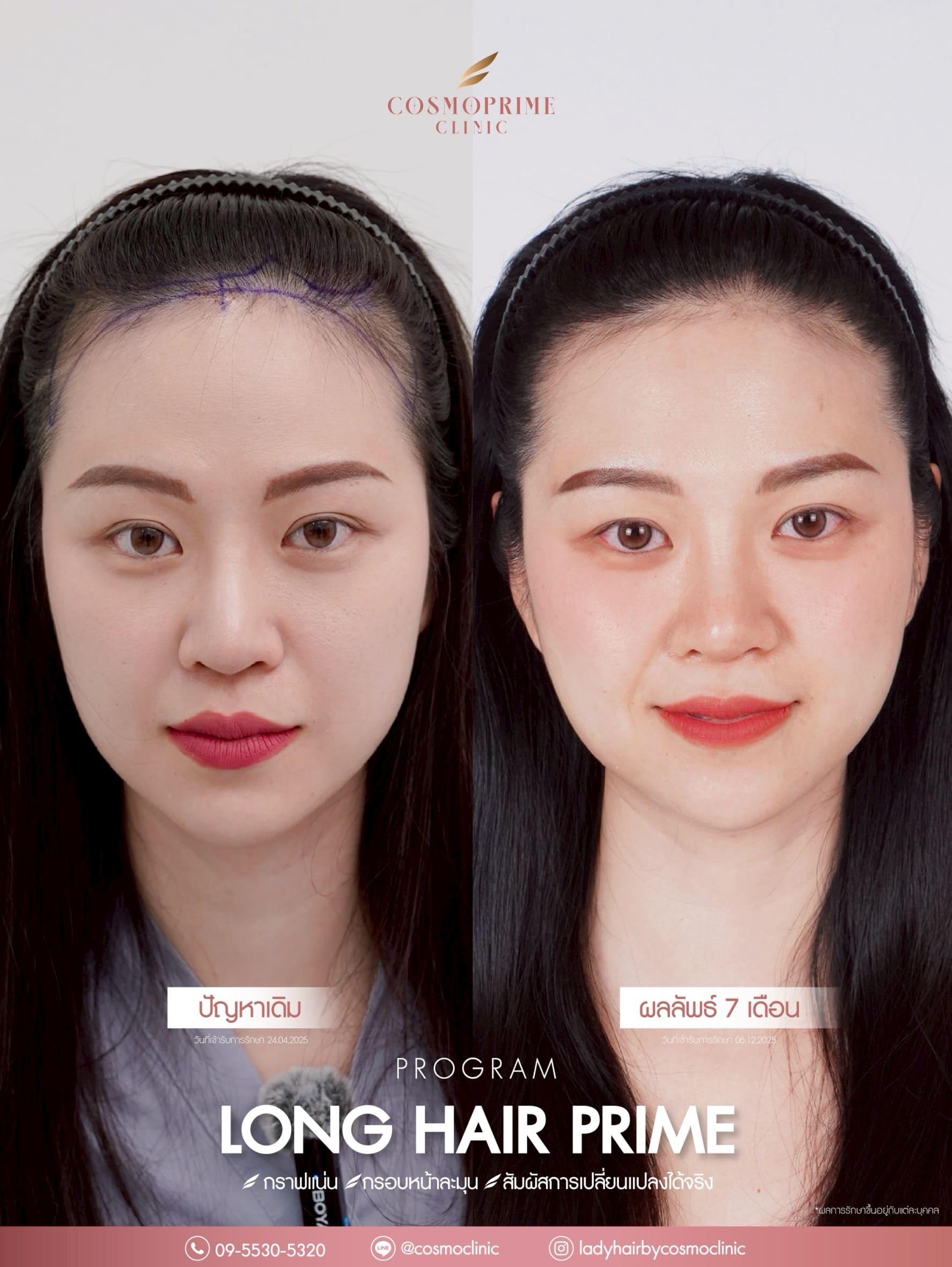 No-Shave Hair Transplant