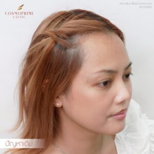 long hair transplant before