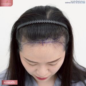 frontal hairline
