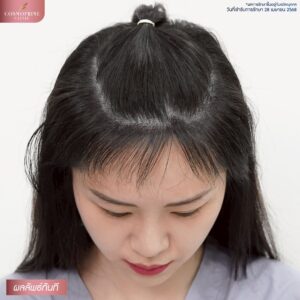 Long Hair Transplant Procedure