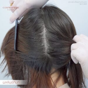 Female patient long hair transplant outcome