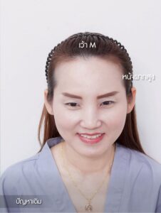 Female long hair transplant hairline improvement
