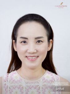 Long hair transplant female hairline result