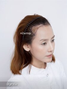 Long hair transplant female forehead correction result