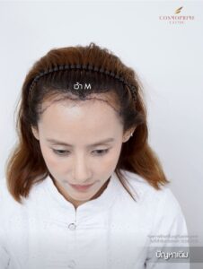 Long hair transplant female result in Bangkok
