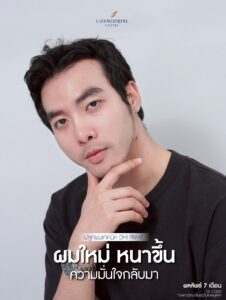 6 to 8 months after FUE hair transplant in male patient, improved hair density and natural hairline result in Bangkok