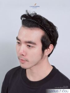 Hair transplant before and after results