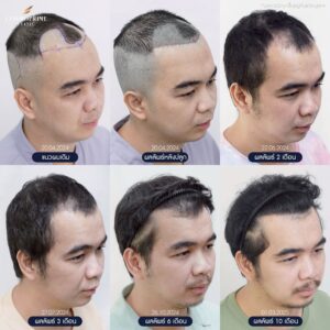 Before and after FUE hair transplant in male patient, restored frontal hairline and improved density at 8 months in Bangkok