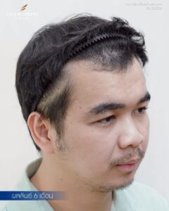 Hair transplant before and after gallery showing real patient results from CosmoPrime Clinic Bangkok
