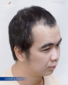 Post-operative donor area after FUE hair transplant, clean healing and preserved density in Bangkok