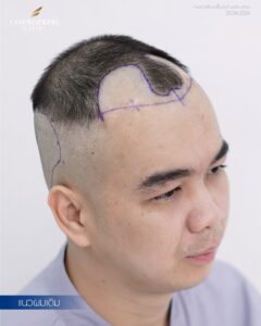 FUE hair transplant result showing natural hair growth after surgery, male patient treated at CosmoPrime Clinic Bangkok