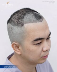 Male hair transplant using FUE technique, before surgery and 6–8 months after result in Bangkok