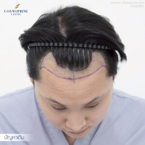 Before FUE hair transplant in male patient with frontal hairline recession, assessment image taken at CosmoPrime Clinic Bangkok