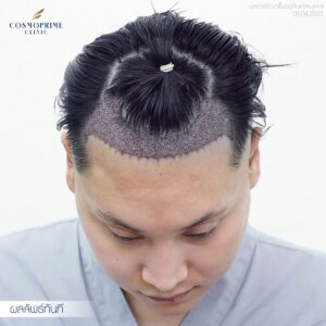 Immediate after FUE hair transplant in male patient with frontal hairline recession, assessment image taken at CosmoPrime Clinic Bangkok