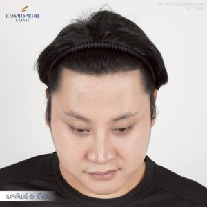 6 months after FUE hair transplant in male patient with frontal hairline recession, assessment image taken at CosmoPrime Clinic Bangkok