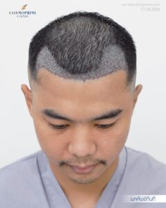 Long hair DHI hair transplant for female patient correcting receding hairline without shaving donor area in Bangkok