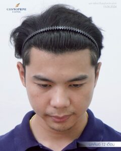 Donor area after long hair DHI hair transplant showing hidden extraction sites and no visible scarring