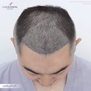 precise hair implantation
