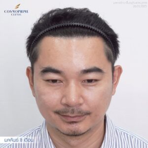 hair implantation